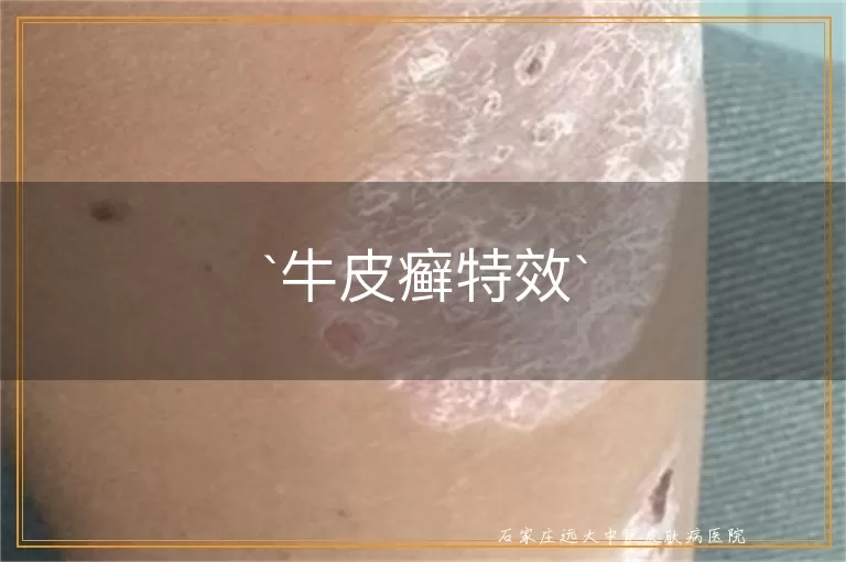牛皮癣特效