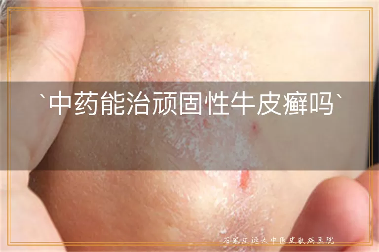 中药能治顽固性牛皮癣吗