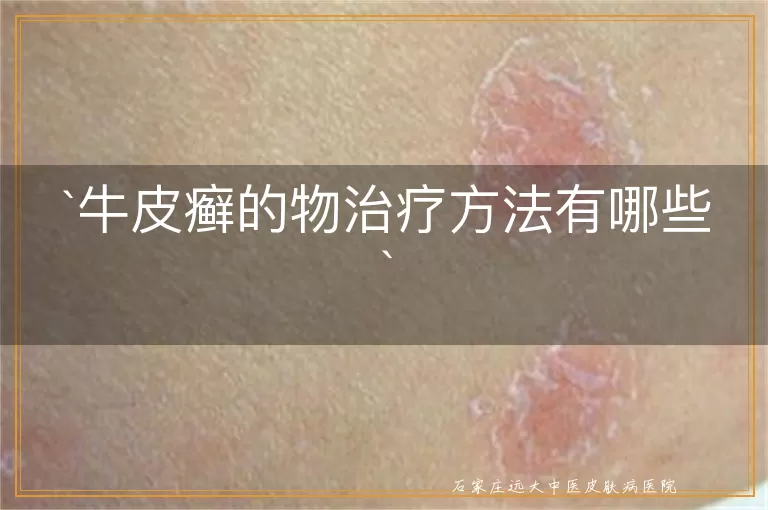 牛皮癣的物治疗方法有哪些