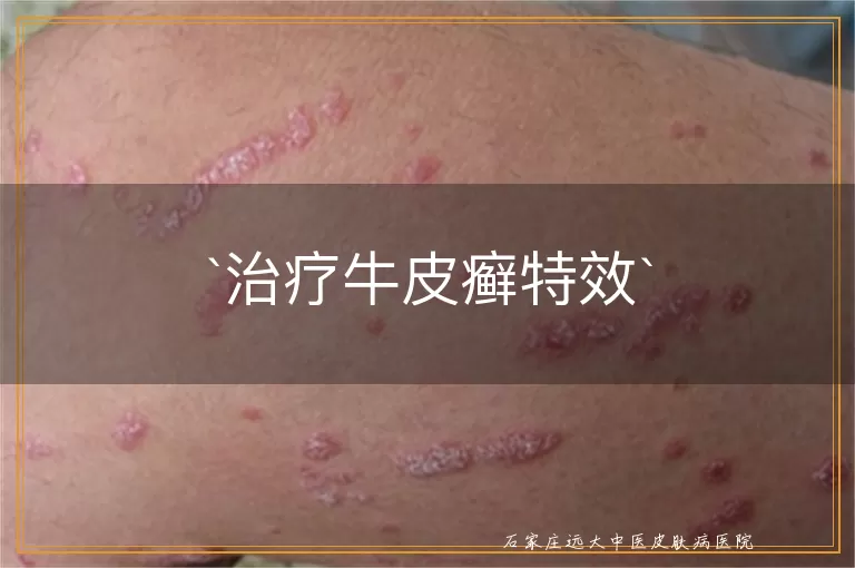 治疗牛皮癣特效