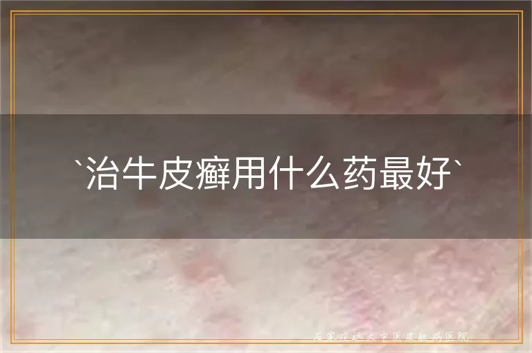 治牛皮癣用什么药最好