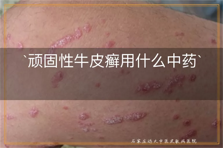 顽固性牛皮癣用什么中药
