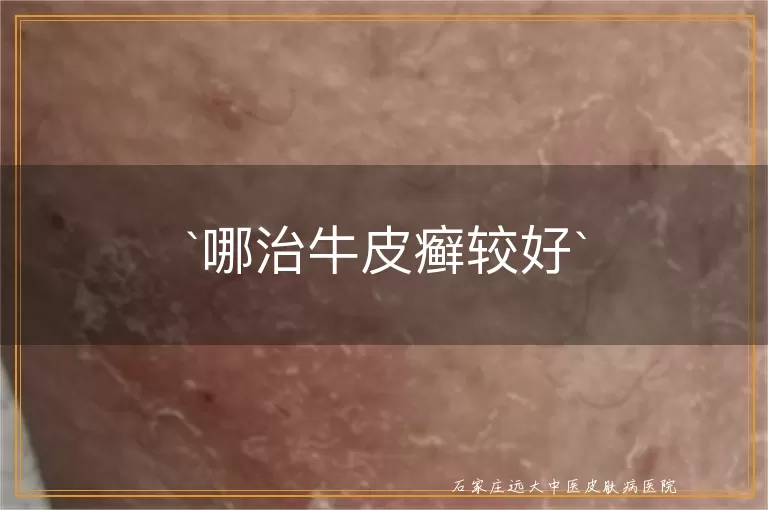哪治牛皮癣较好
