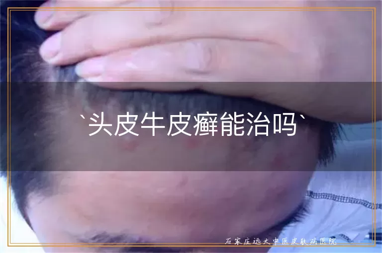 头皮牛皮癣能治吗