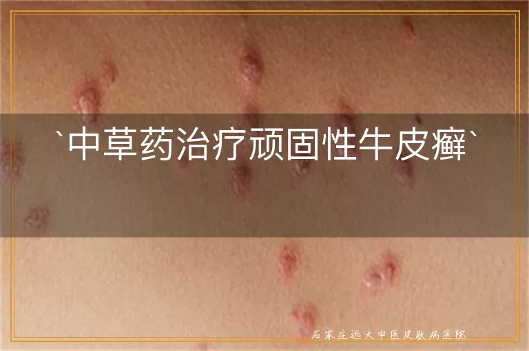 中草药治疗顽固性牛皮癣