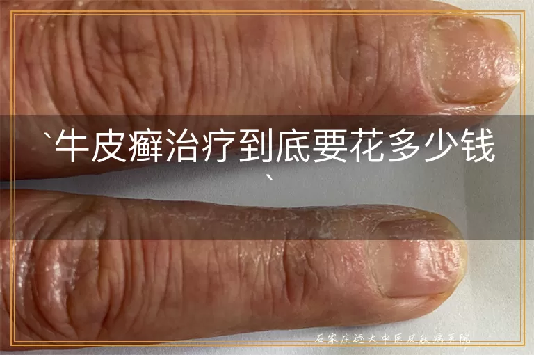 牛皮癣治疗到底要花多少钱