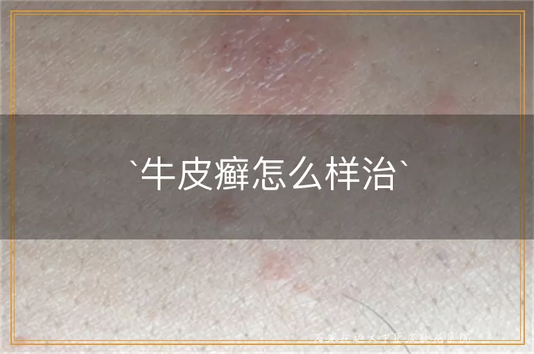 牛皮癣怎么样治
