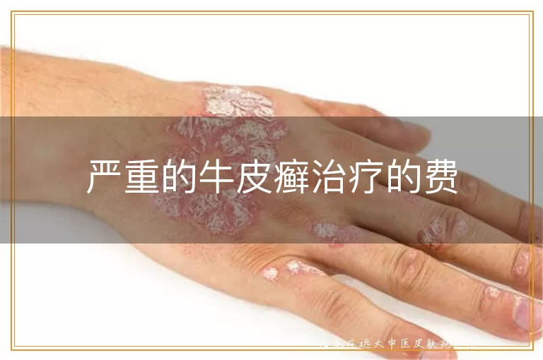 严重的牛皮癣治疗的费