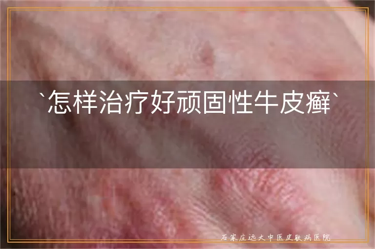 怎样治疗好顽固性牛皮癣