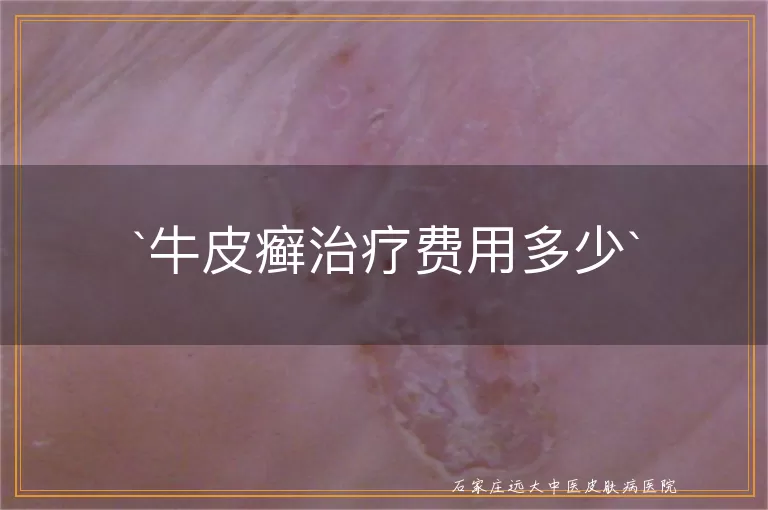 牛皮癣治疗费用多少