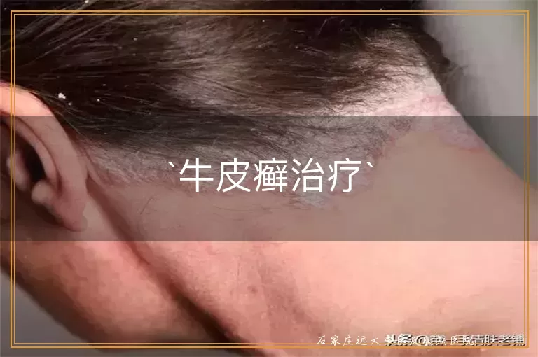 牛皮癣治疗