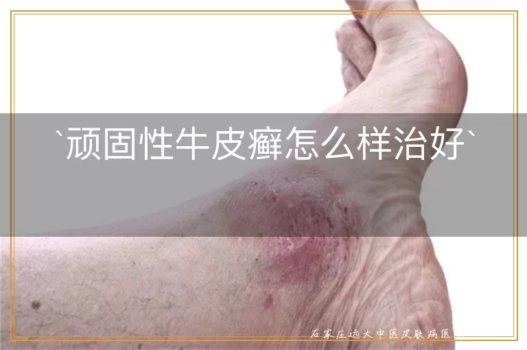 顽固性牛皮癣怎么样治好