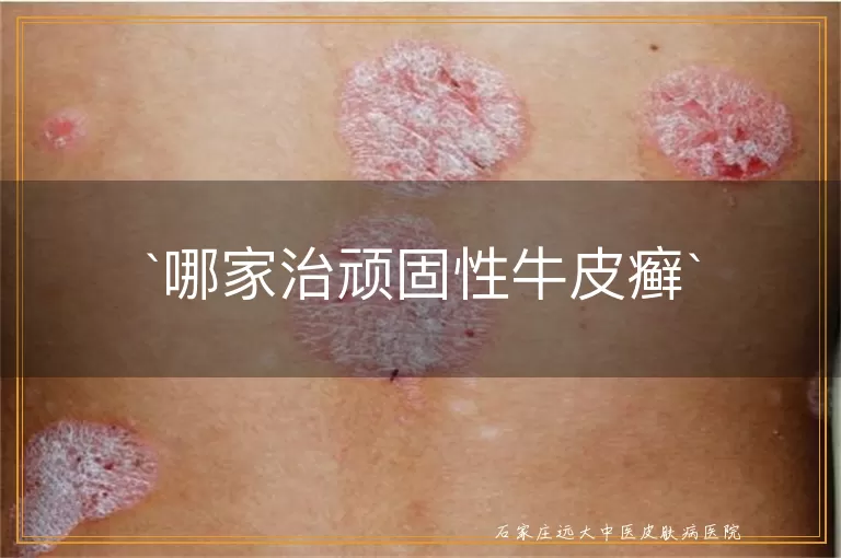 哪家治顽固性牛皮癣
