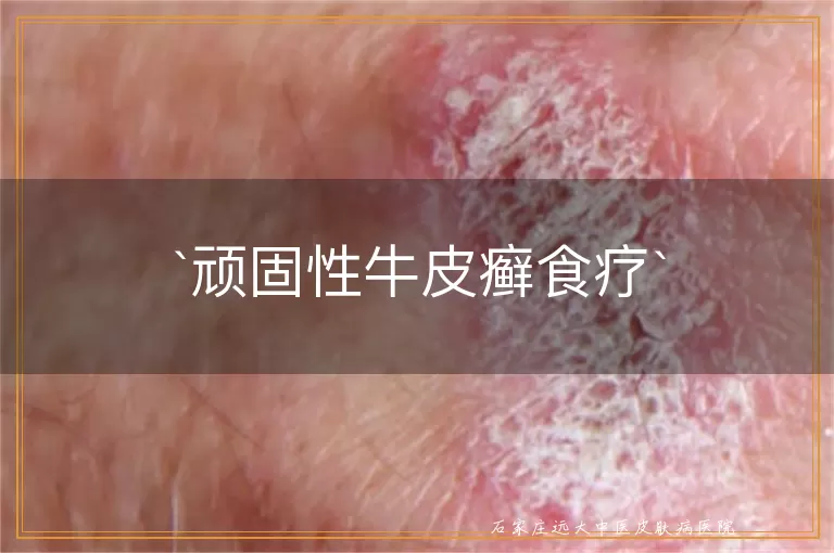 顽固性牛皮癣食疗