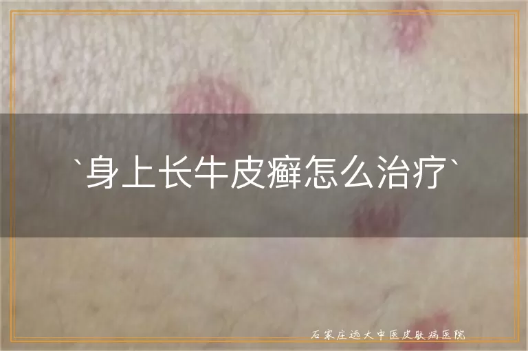 身上长牛皮癣怎么治疗