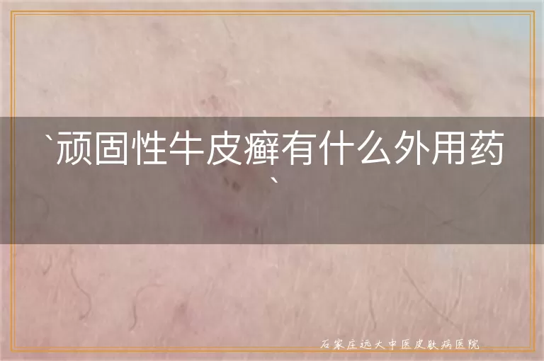 顽固性牛皮癣有什么外用药