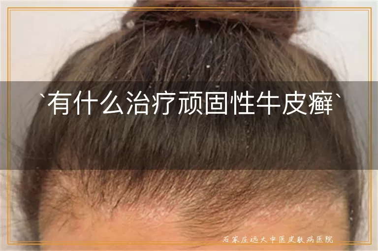 有什么治疗顽固性牛皮癣