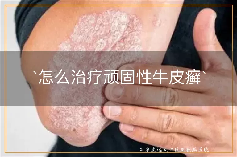 怎么治疗顽固性牛皮癣