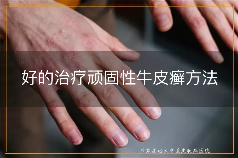 好的治疗顽固性牛皮癣方法