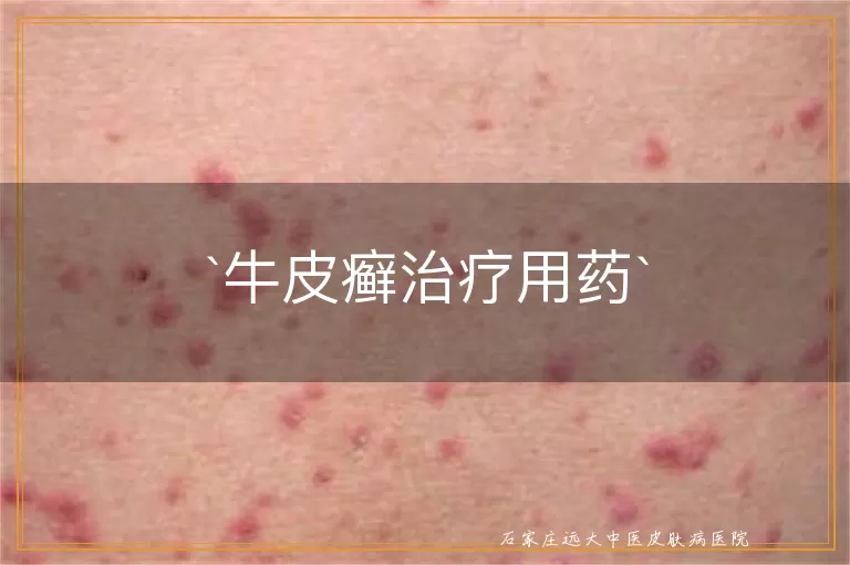 牛皮癣治疗用药