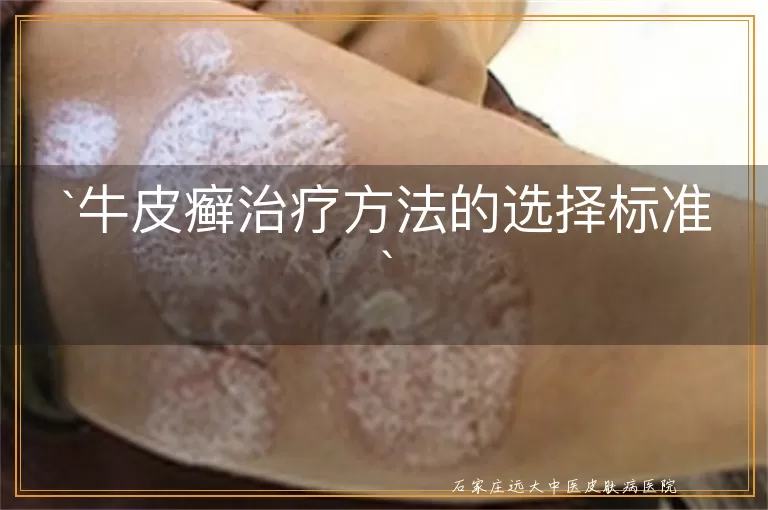 牛皮癣治疗方法的选择标准