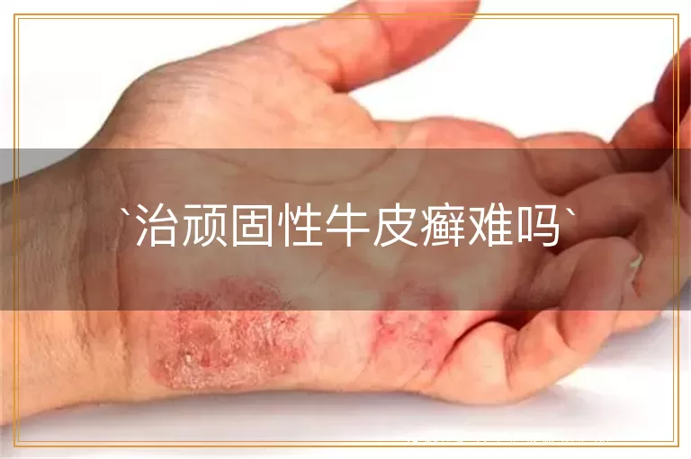 治顽固性牛皮癣难吗