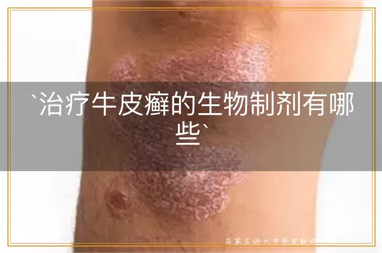 治疗牛皮癣的生物制剂有哪些