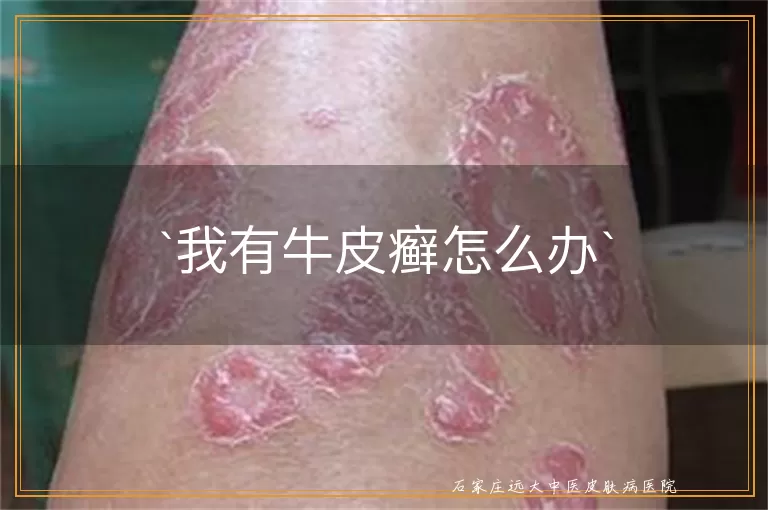 我有牛皮癣怎么办