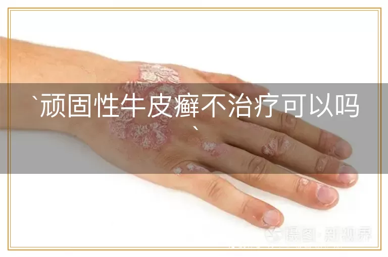 顽固性牛皮癣不治疗可以吗
