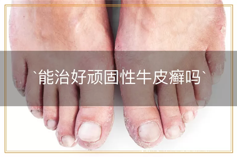 能治好顽固性牛皮癣吗