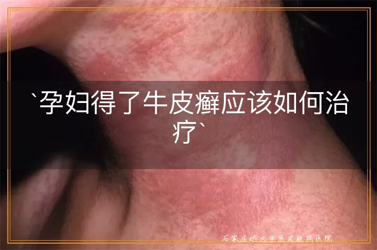 孕妇得了牛皮癣应该如何治疗