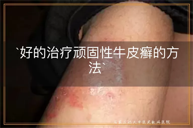 好的治疗顽固性牛皮癣的方法