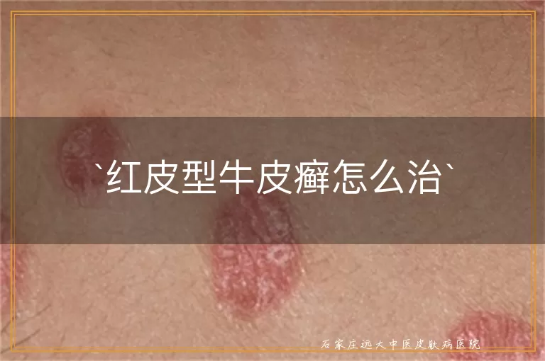 红皮型牛皮癣怎么治