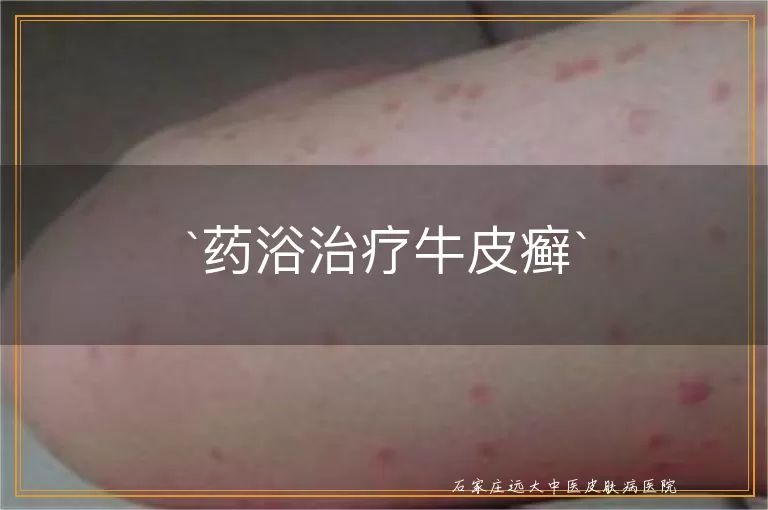 药浴治疗牛皮癣
