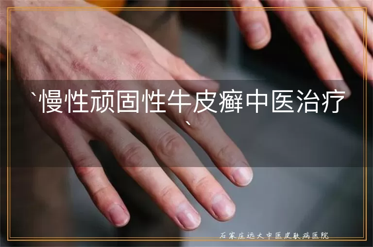 慢性顽固性牛皮癣中医治疗