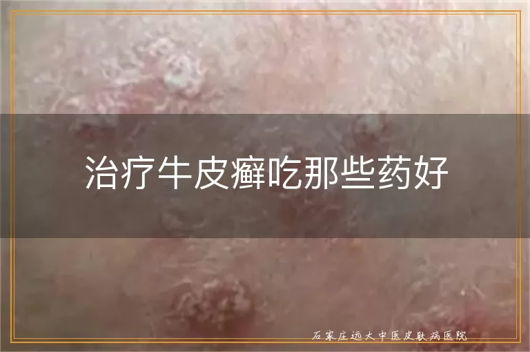 治疗牛皮癣吃那些药好