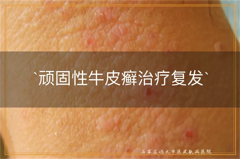 顽固性牛皮癣治疗复发