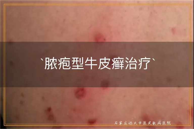 脓疱型牛皮癣治疗