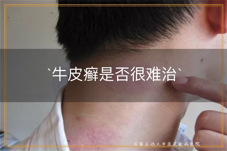 牛皮癣是否很难治