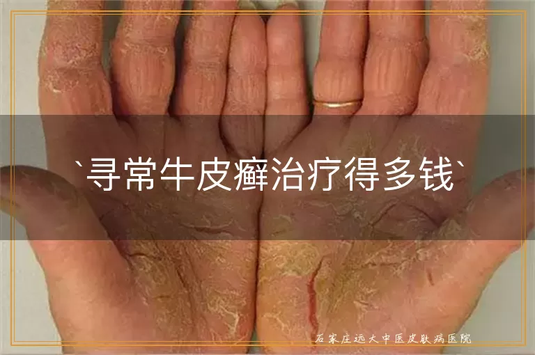 寻常牛皮癣治疗得多钱