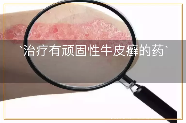 治疗有顽固性牛皮癣的药