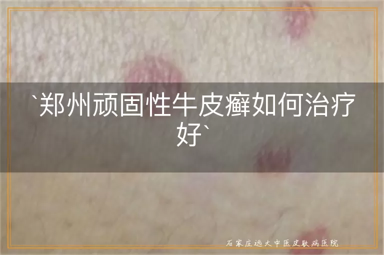 郑州顽固性牛皮癣如何治疗好