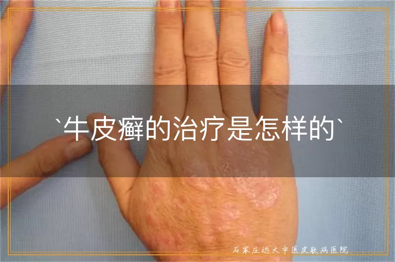 牛皮癣的治疗是怎样的