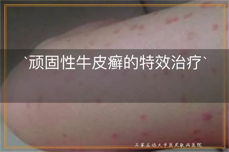 顽固性牛皮癣的特效治疗