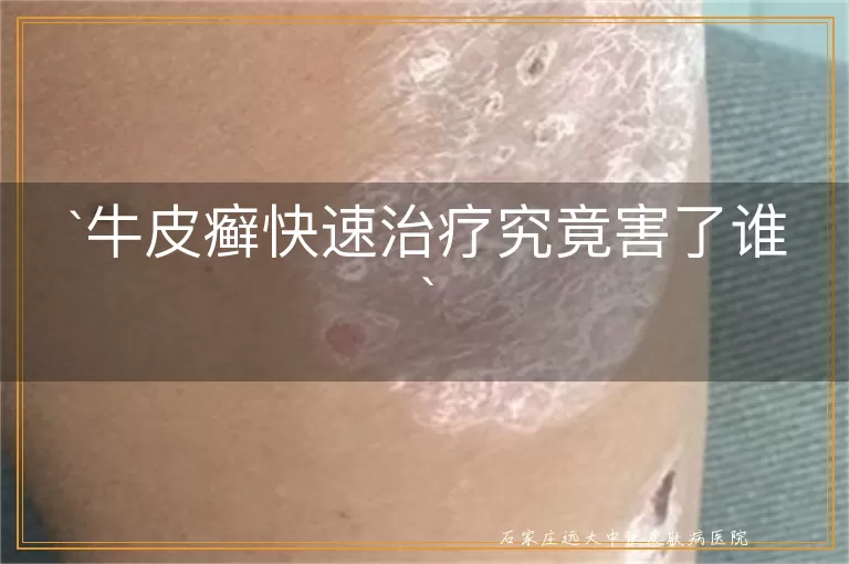 牛皮癣快速治疗究竟害了谁