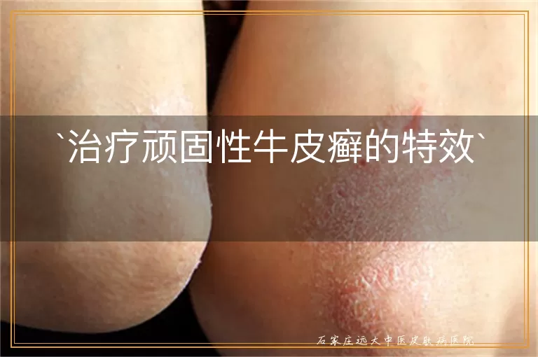 治疗顽固性牛皮癣的特效