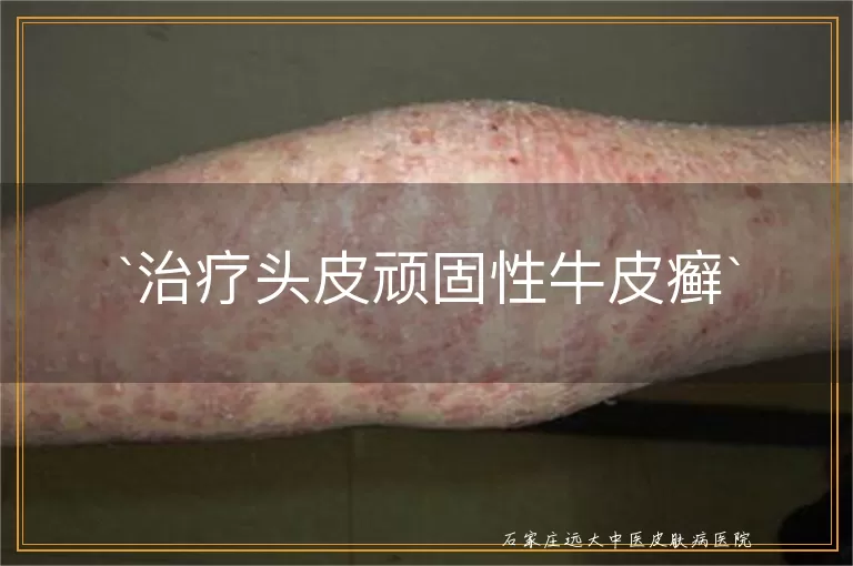 治疗头皮顽固性牛皮癣