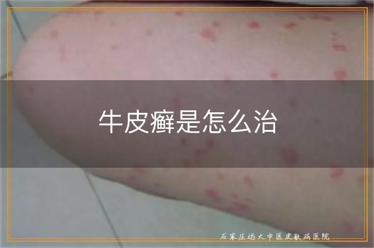 牛皮癣是怎么治