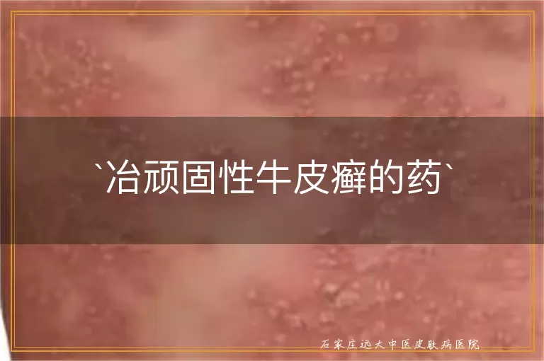 冶顽固性牛皮癣的药