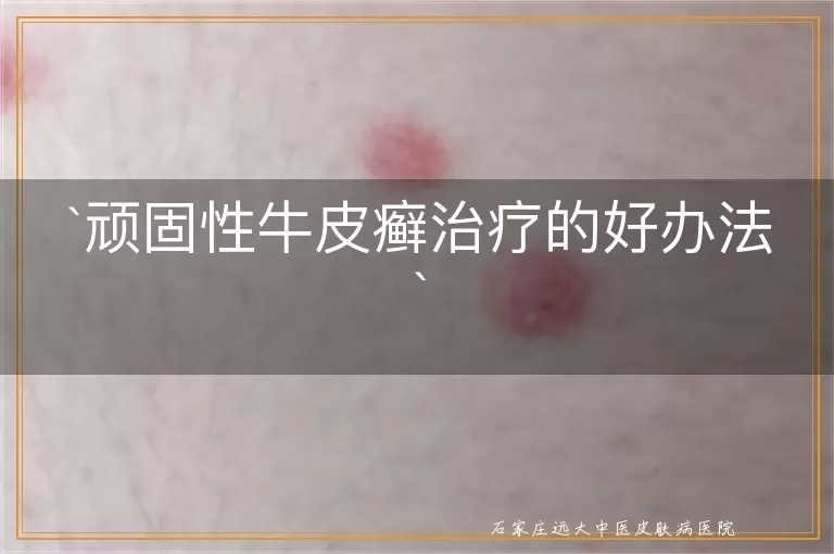 顽固性牛皮癣治疗的好办法